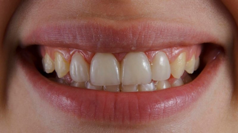 How Microsurgery is Redefining Modern Tooth Retention
